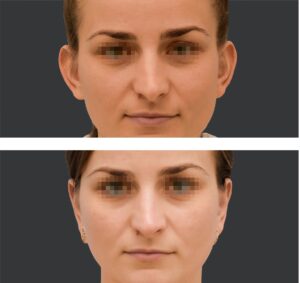 Plastyka odstających uszu efekty
